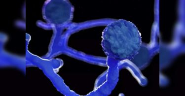 Nagpur: Doctors detect mucorikosis in the human intestine