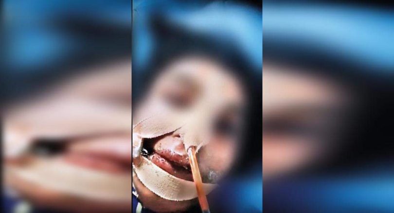 Ants crawl in paralytic patients Covid-19