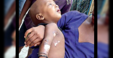 Babies suffered burns during the RPF drive at Charbagh Station