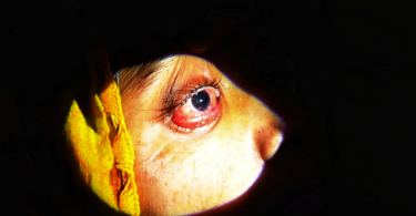 India reported 45,374 black mushroom cases, 4,332 deaths so far, the Ministry of Health said