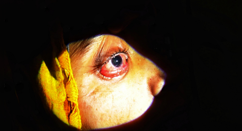 India reported 45,374 black mushroom cases, 4,332 deaths so far, the Ministry of Health said