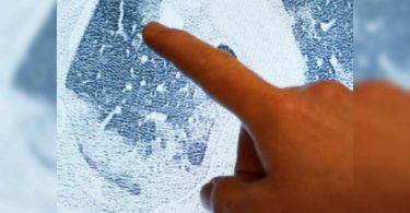 Lung Hit Covid who severely recovered in 3 months, the study said