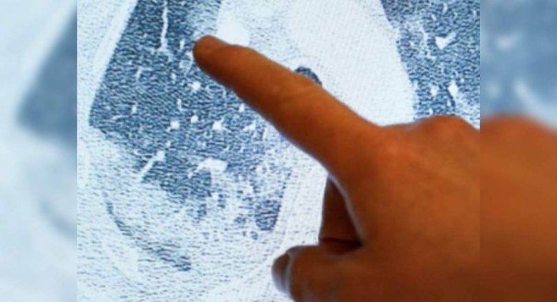 Lung Hit Covid who severely recovered in 3 months, the study said