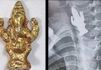 B'luru: 3-year-old boy swallowed Ganesha Idol, survived