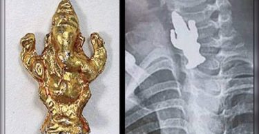B'luru: 3-year-old boy swallowed Ganesha Idol, survived