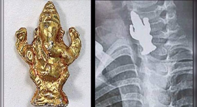 B'luru: 3-year-old boy swallowed Ganesha Idol, survived