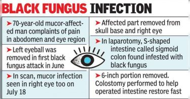The doctor detected the mucor on the human intestine during a relapse operation