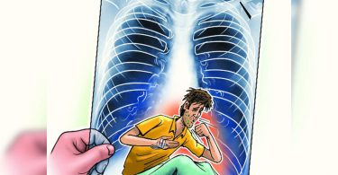 Patients who have recovered from Covid are vulnerable to tuberculosis