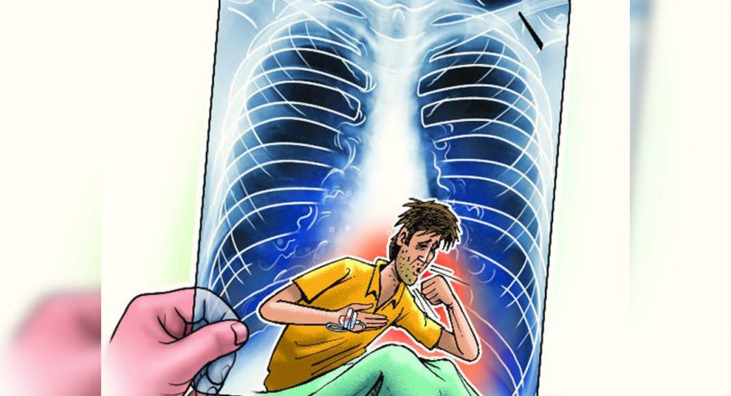 Patients who have recovered from Covid are vulnerable to tuberculosis