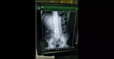 Bengaluru: Enema helps the police find a rowdy chain swallowing