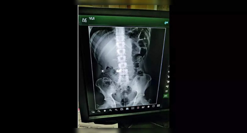 Bengaluru: Enema helps the police find a rowdy chain swallowing